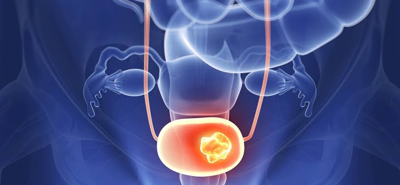 TREATMENT OF URINARY BLADDER CANCER